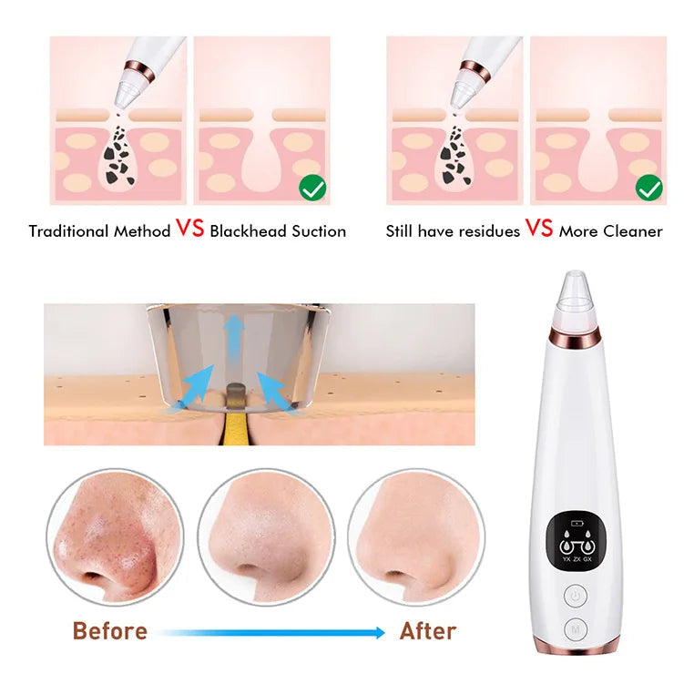 5-in-1 Electric Blackhead Remover Vacuum | Rechargeable Pore Cleaner with Acne Suction & Deep Facial Skin Care Tool